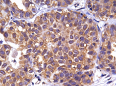 图2左边是早期乳腺癌中G1P3的过表达.